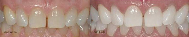 Teeth Whitening Livonia after