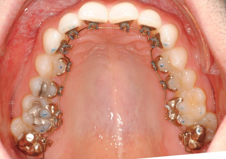 IncognitoHiddenBraces (3) Masri Orthodontics