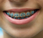 braces-for-children