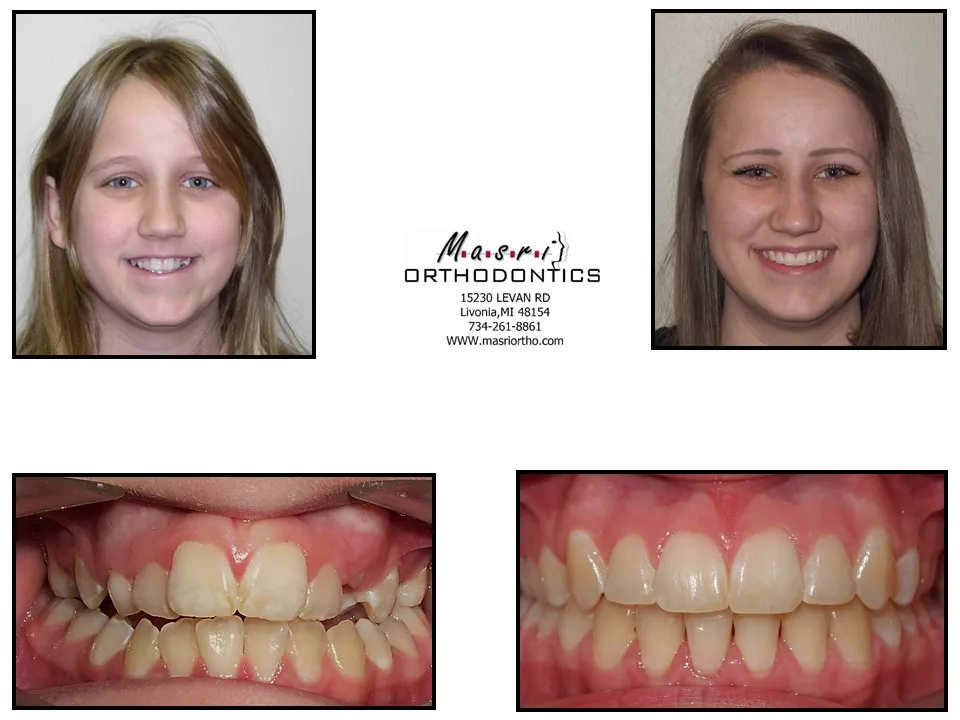 Smile transformation before and after case 6 at Masri Orthodontics