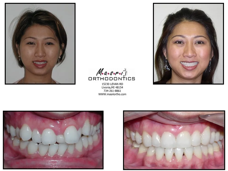 Smile transformation before and after case 9 at Masri Orthodontics
