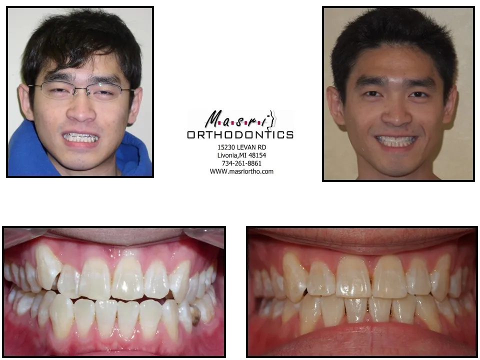 Smile transformation before and after case 8 at Masri Orthodontics