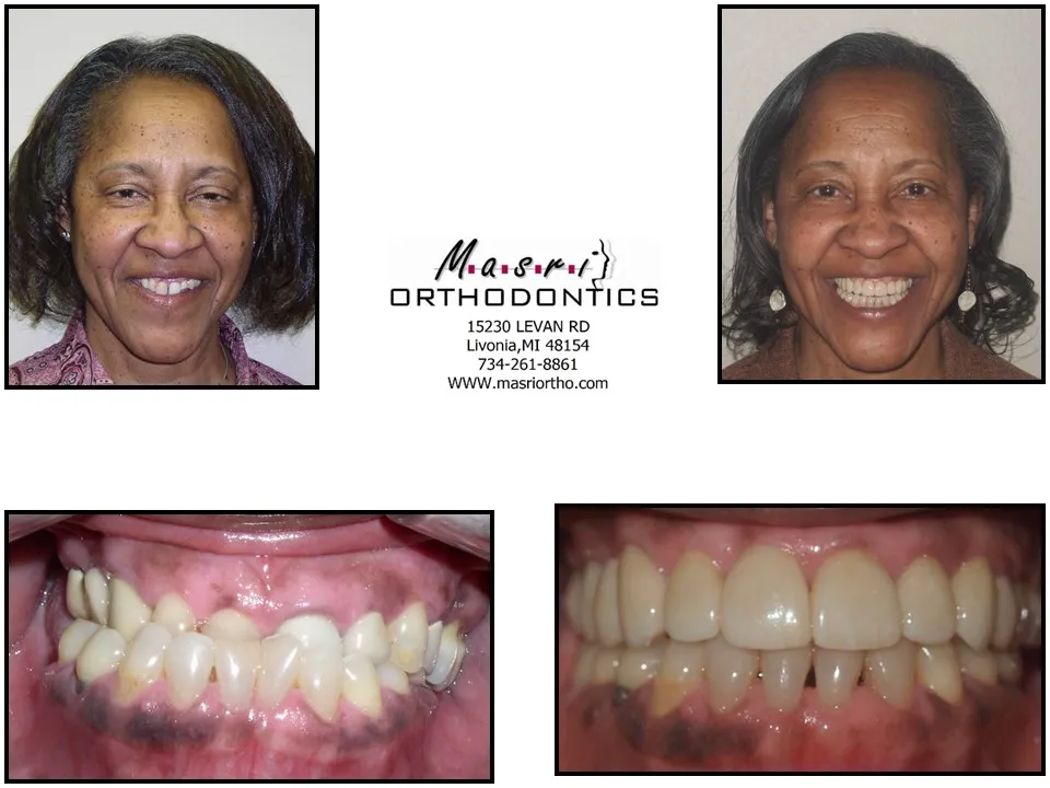 Smile transformation before and after case 1 at Masri Orthodontics
