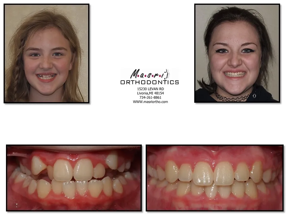 Smile transformation before and after case 4 at Masri Orthodontics