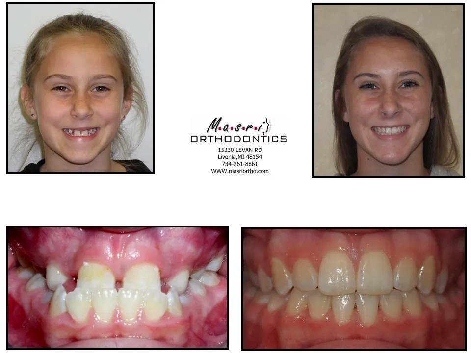 Smile transformation before and after case 7 at Masri Orthodontics