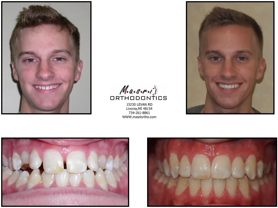 Smile transformation before and after case 5 at Masri Orthodontics