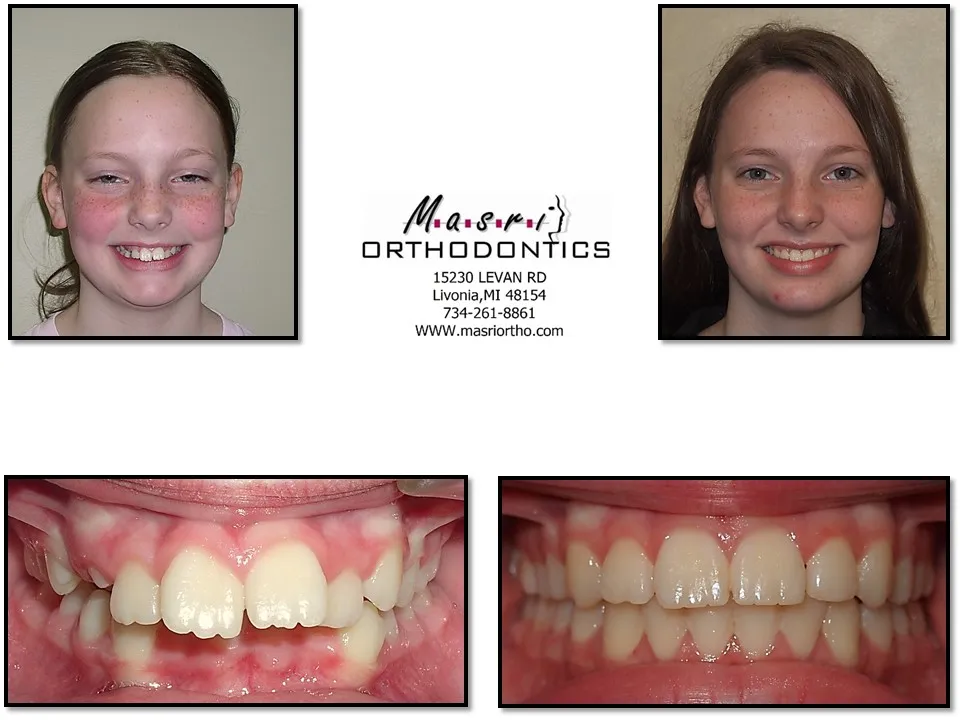 Smile transformation before and after case 10 at Masri Orthodontics