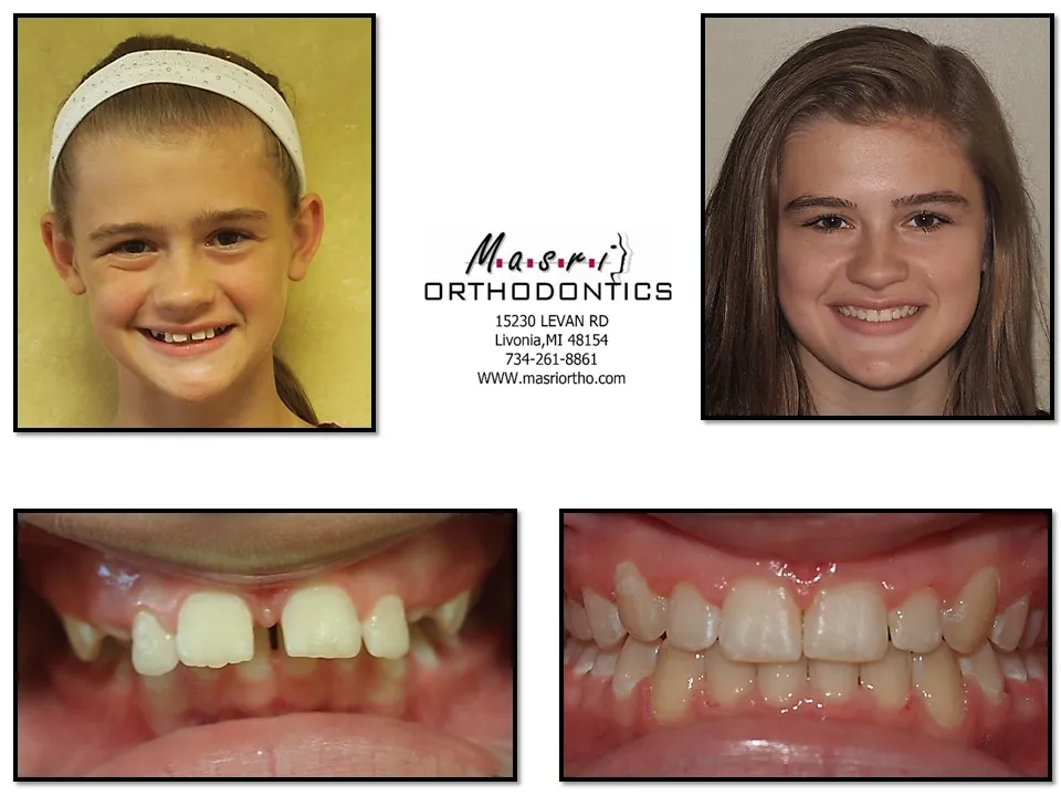 Smile transformation before and after case 12 at Masri Orthodontics