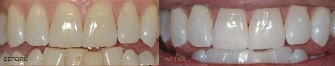 Teeth Whitening Livonia after
