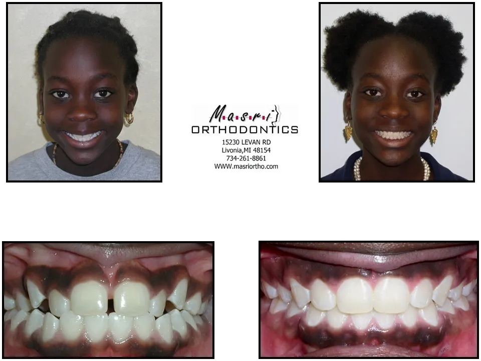 Smile transformation before and after case 3 at Masri Orthodontics