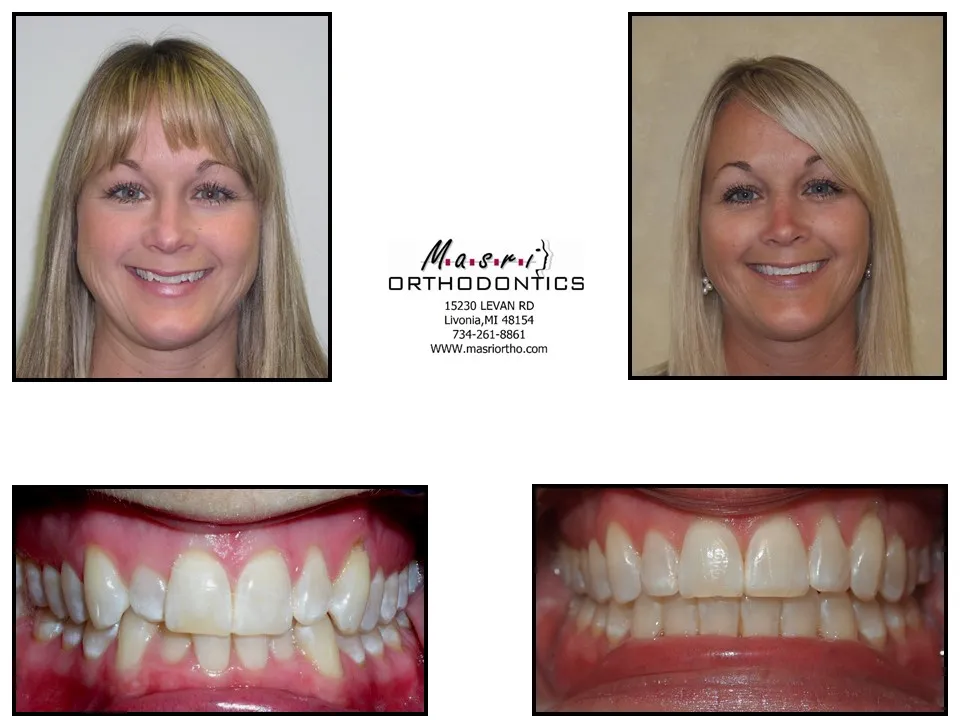 Smile transformation before and after case 2 at Masri Orthodontics