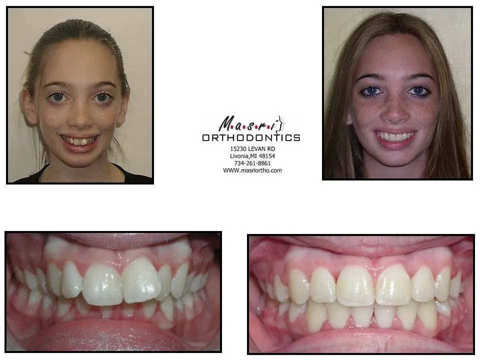 Smile transformation before and after case 11 at Masri Orthodontics