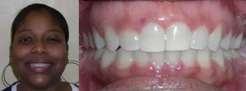 After jaw surgery