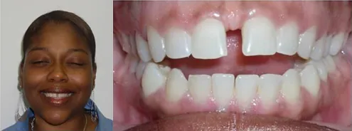 Before jaw surgery