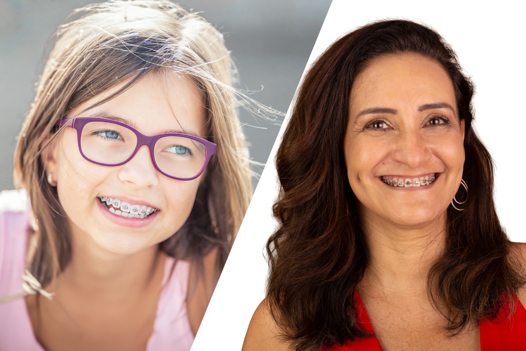Braces At Different Age