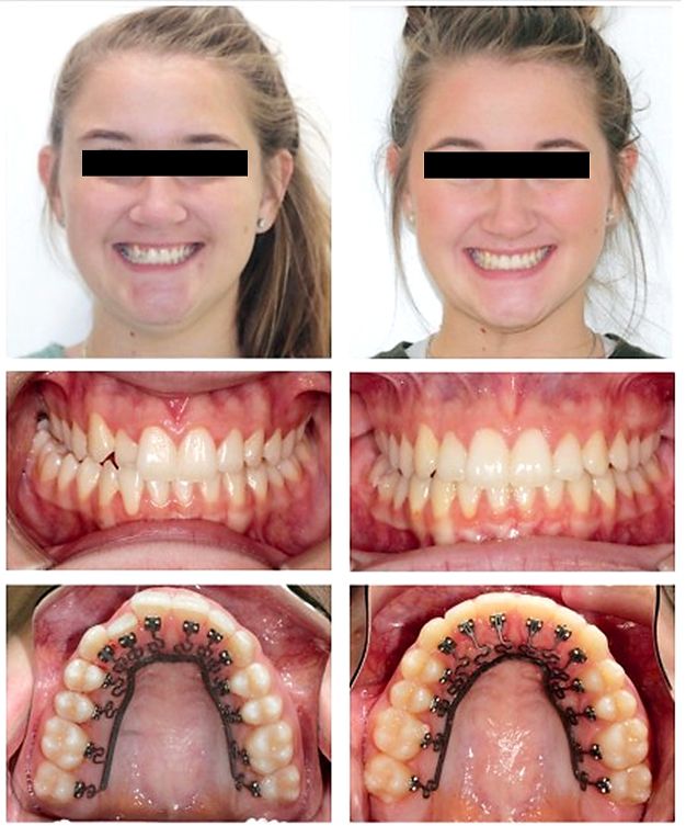 Before and after photos of BRIUS lingual braces treatment