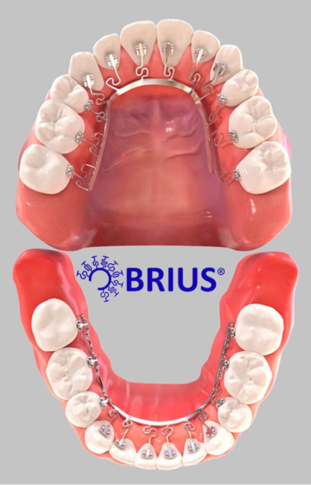 Brava by Brius lingual braces by masri orthodontics