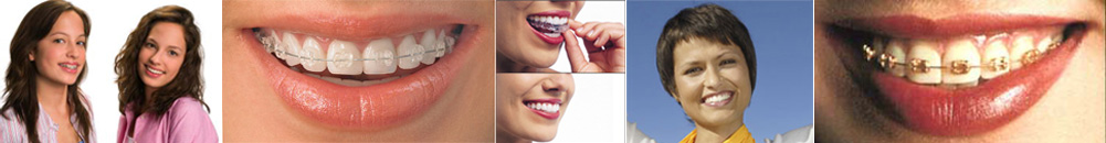 Types of braces